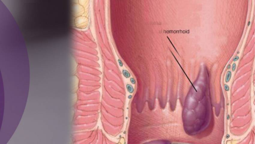 Piles & Fistula